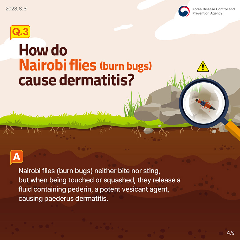 Q3. How do Nairobi flies (burn bugs) cause dermatitis? Nairobi flies (burn bugs) neither bite nor sting, but when being touched or squashed, they release a fluid containing pederin, a potent vesicant agent, causing paederus dermatitis.